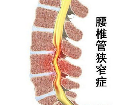 腰痛以及下肢的麻木,疼痛; 2,如狭窄进一步加重,导致椎管血液循环障碍