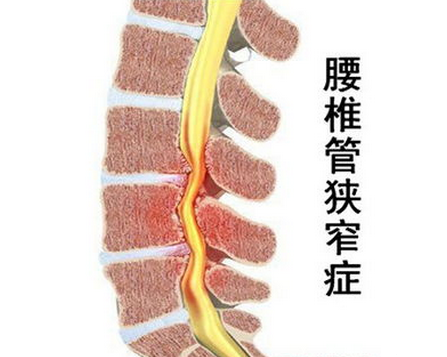 当老年人遇上腰椎椎管狭窄该怎么办?