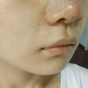 鼻综合整形是大事 术后护理别小瞧 马虎不得 李昕执业医师 爱问医生