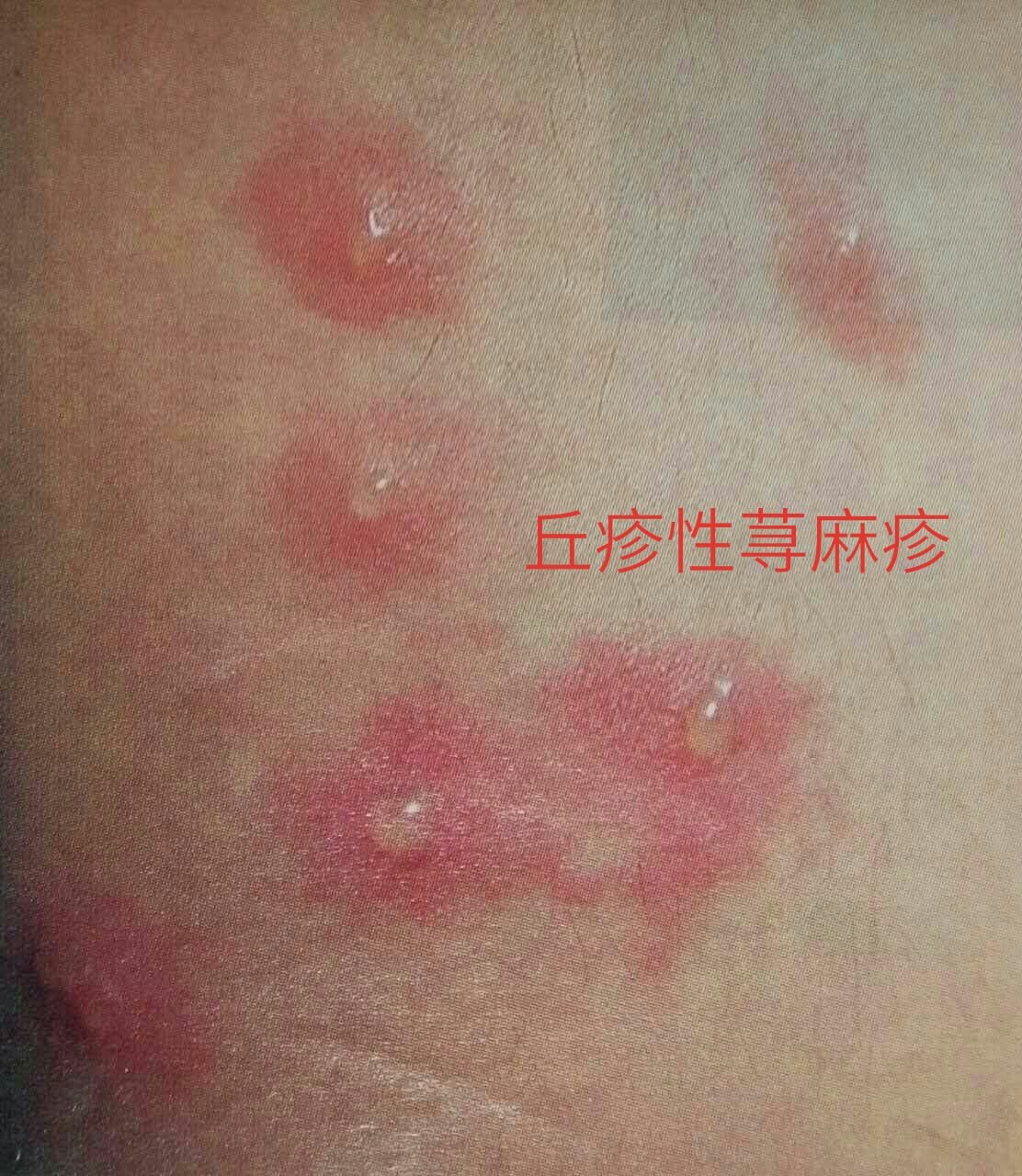 宝宝夏季皮肤保卫战
