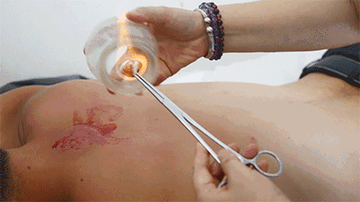 走罐医生也应该仔细询问病人的肺部慢性病史,这样才能安全有效的运用