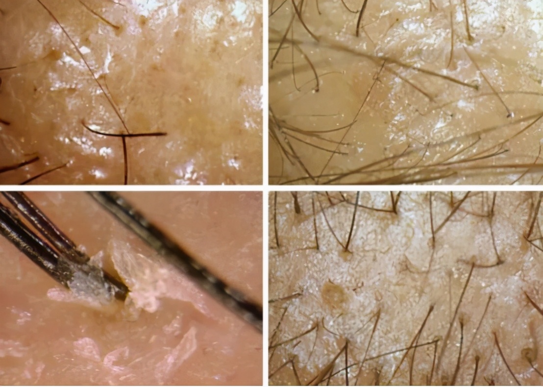 如果有这些问题,做完毛囊检测就可以及时的改善,让头皮毛囊健康,这样