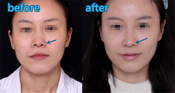 那究竟什么是 鼻翼缘呢?