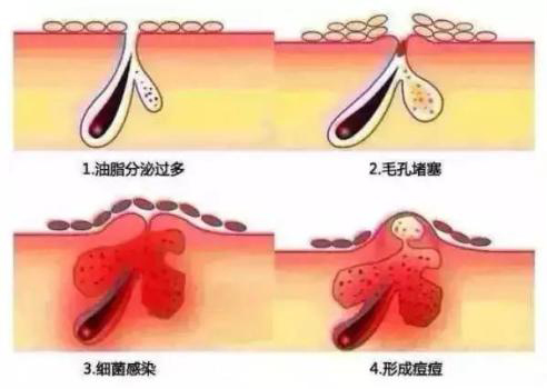 最强科普|螨虫会引发哪些皮肤问题,你想知道的都在这里