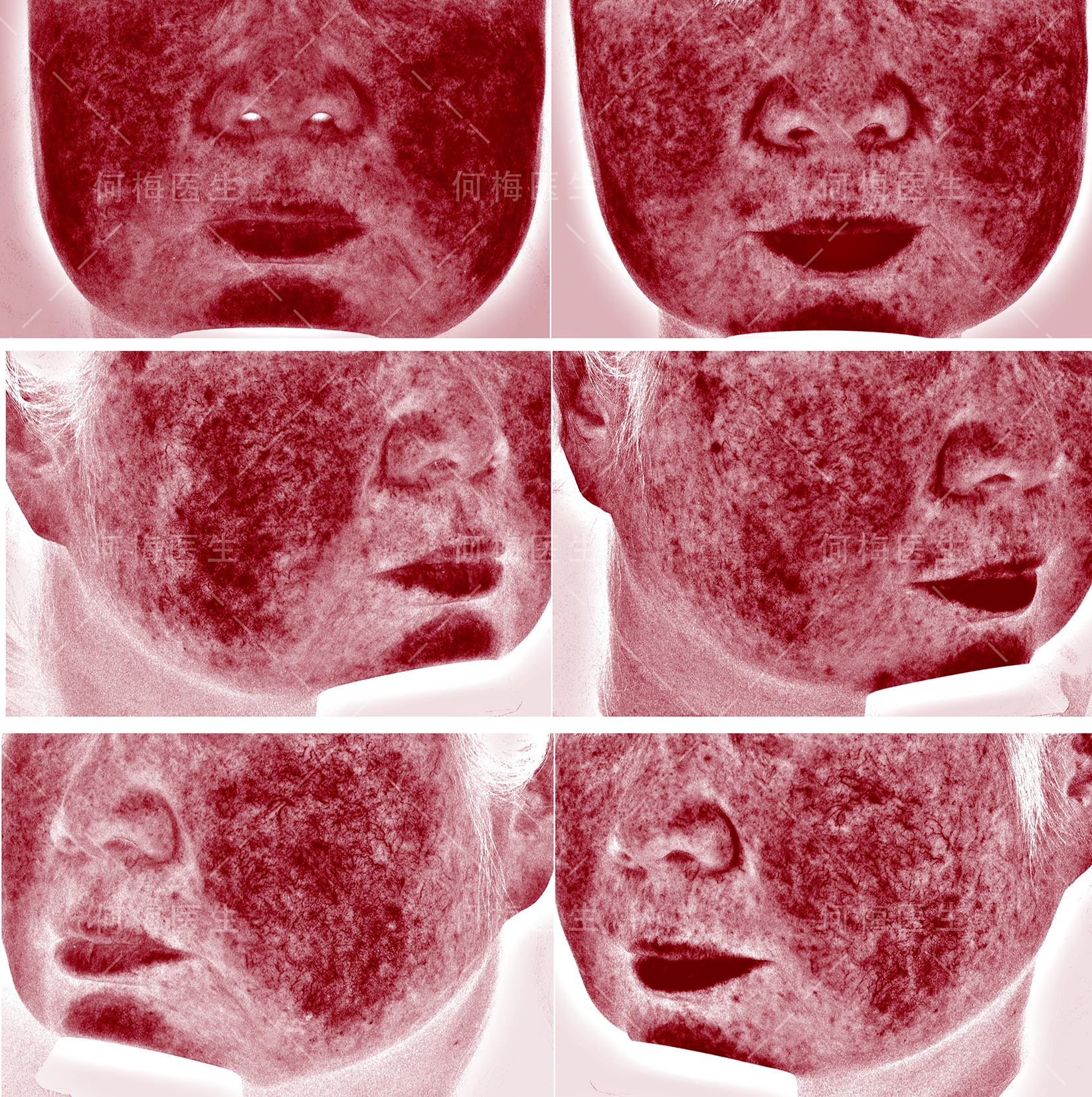 玫瑰痤疮,敏感肌,为什么老是治不好?-何梅副主任医师-爱问医生