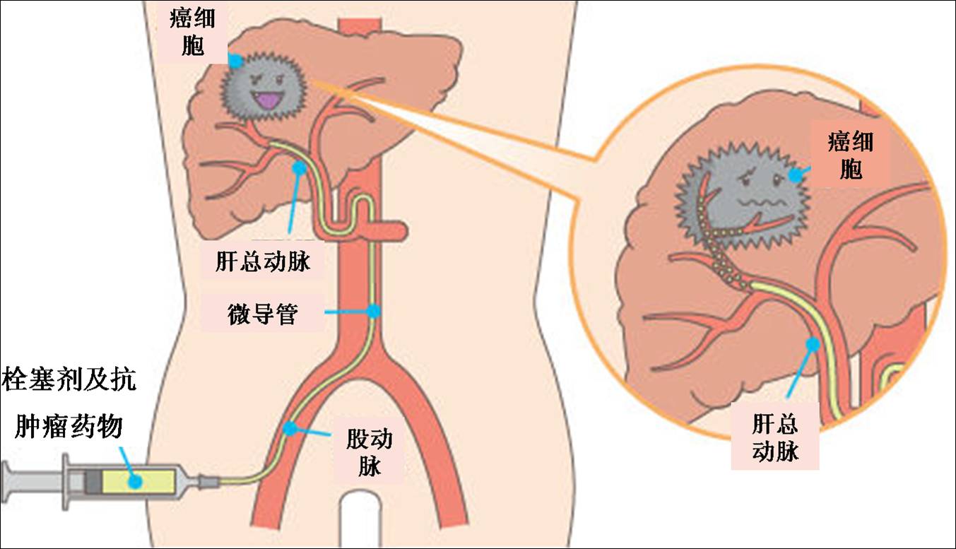 肝动脉化疗栓塞术(tace)联合微波等热消融技术已经充分体现出其临床