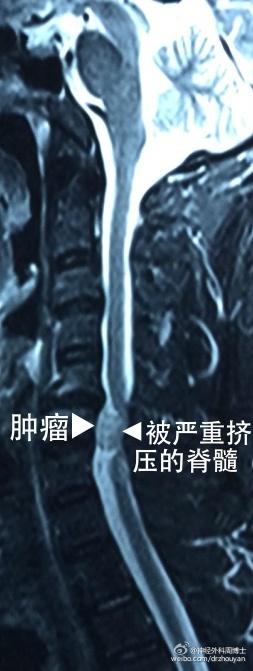 “腿麻”不都是腰椎间盘突出的事 不要忘了肿瘤