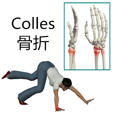 colles骨折定义图片