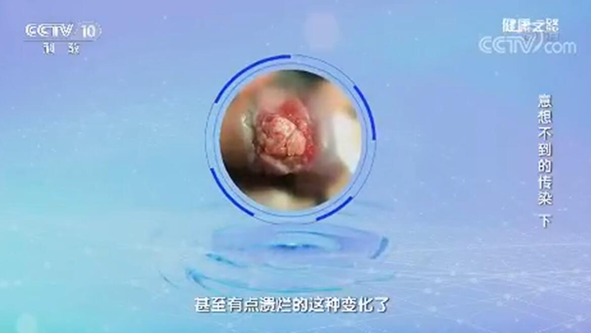 意想不到的传染-----老婆宫颈病变,老公阴茎癌,悔不当初