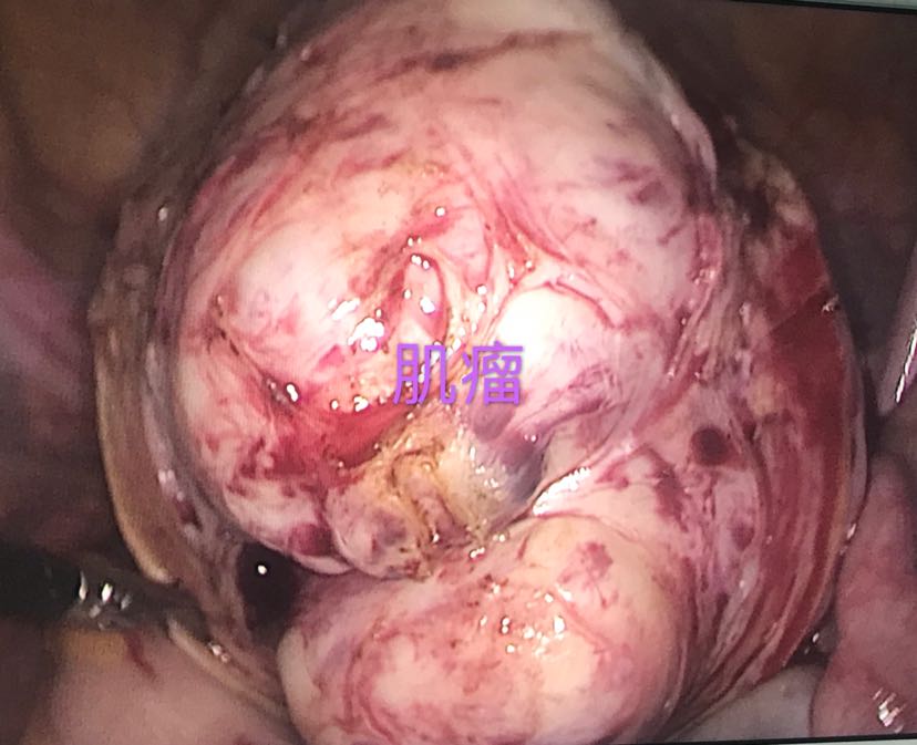 诊间日记年轻女性子宫肌瘤