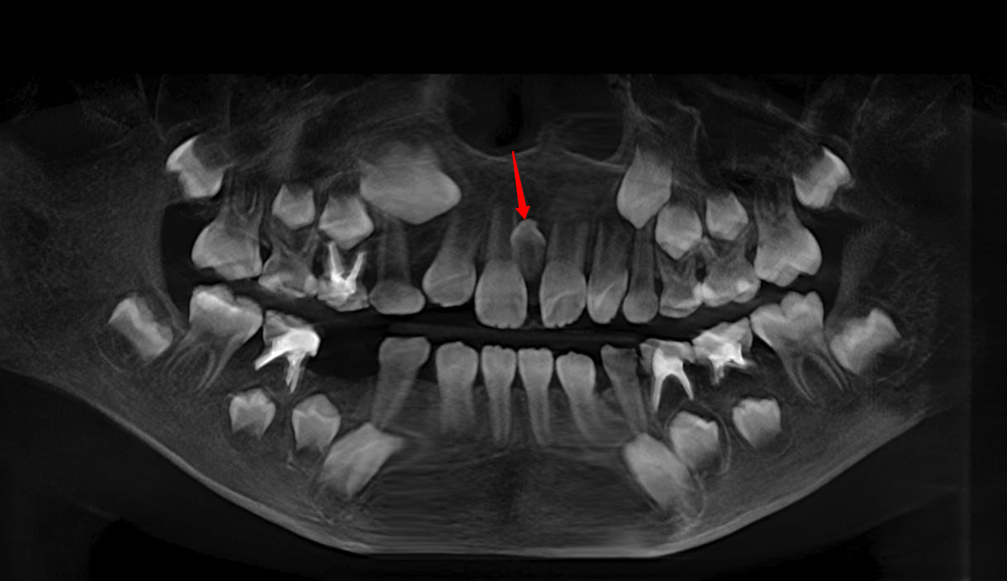 小孩牙齿CT图片