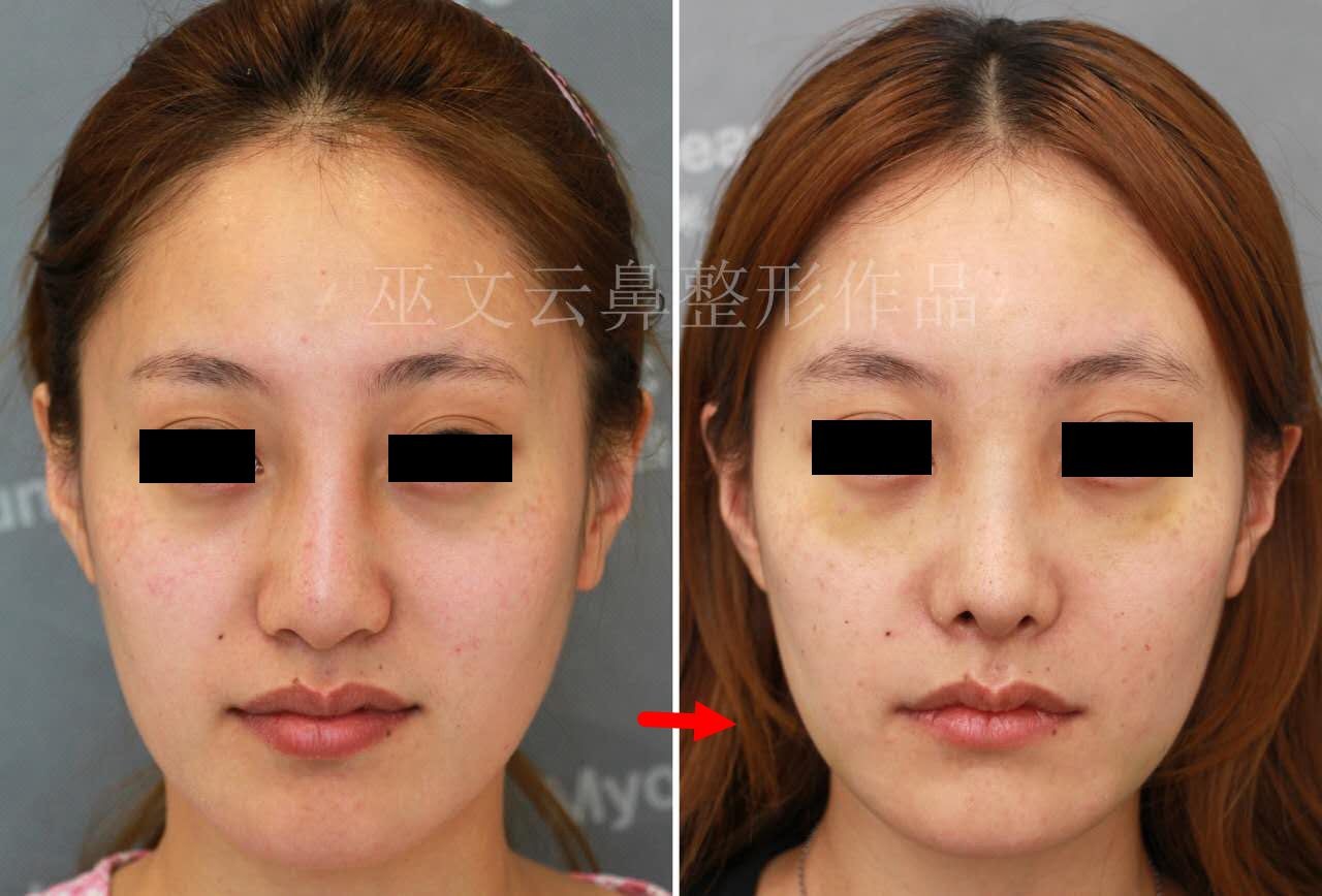 玻尿酸隆鼻术后鼻子越来越宽怎么办?