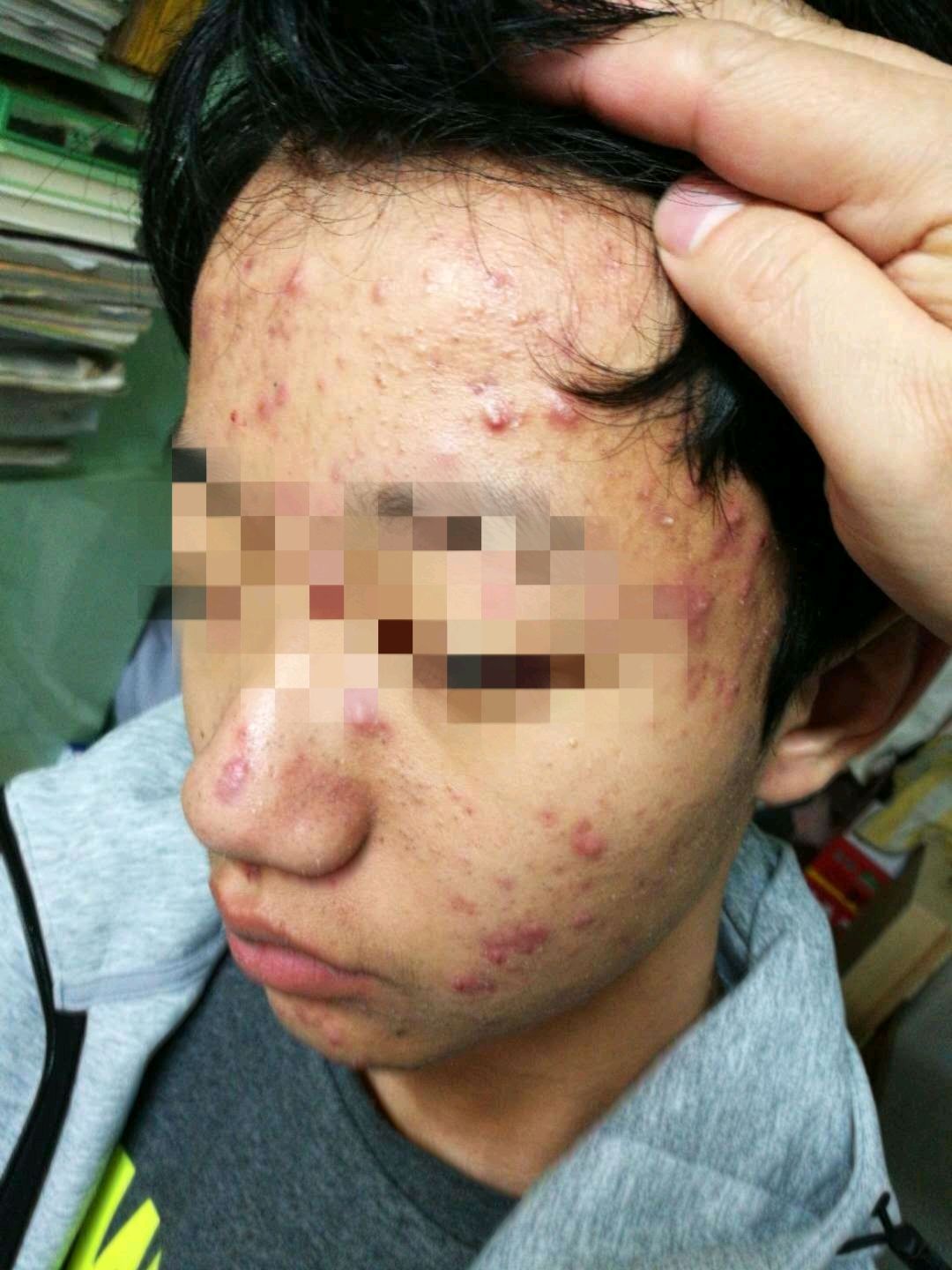 为什么孩子读高中面部的青春痘越来越严重?-张华副主任医师-爱问医生