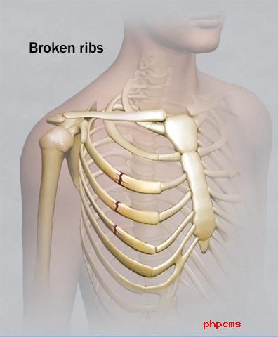 撞到肋骨骨折,冷静对待
