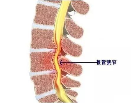 不同节段发生椎管狭窄,症状各不相同