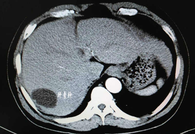 肝囊肿是什么原因引起的?