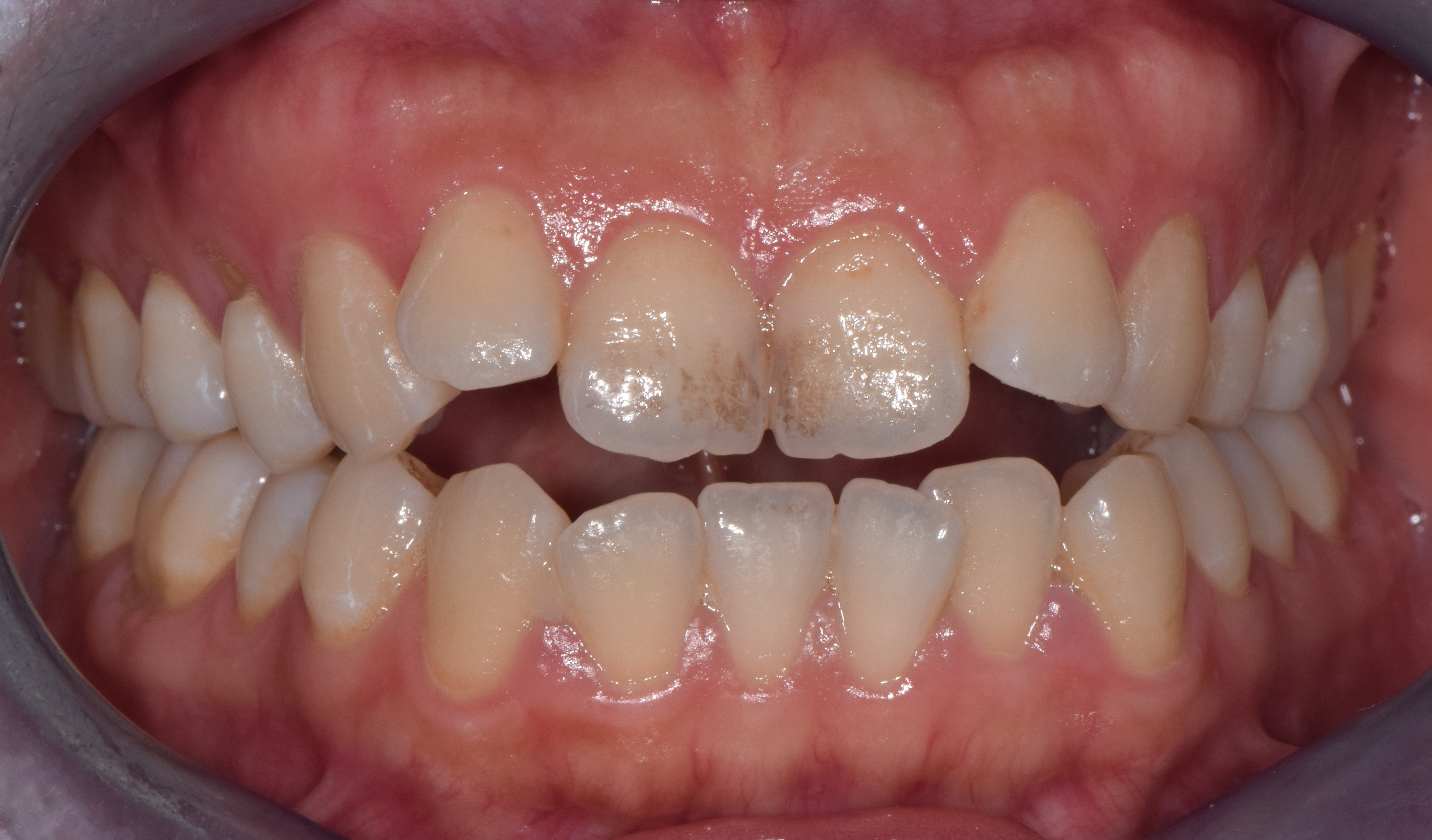 开颌矫正第一招:压低后牙,前旋下颌-梁爱燕主治医师-爱问医生