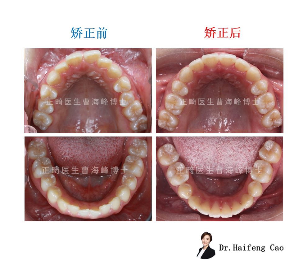 儿童露龈笑几岁矫正图片