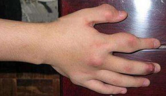 痛风会引起手指伸直疼吗