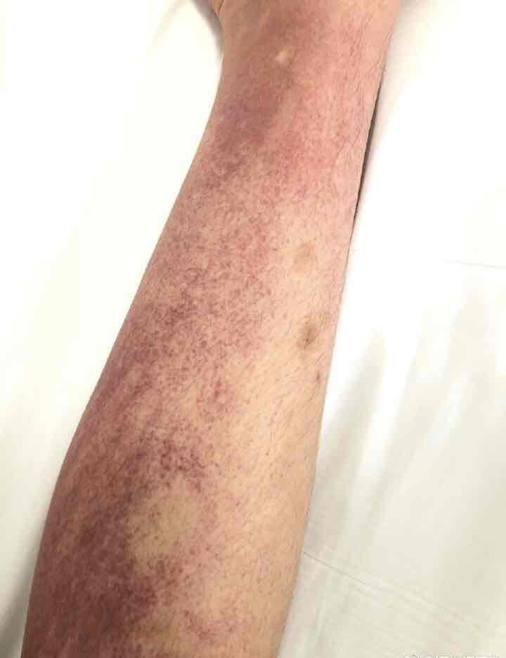 过敏性紫癜治疗前后对比