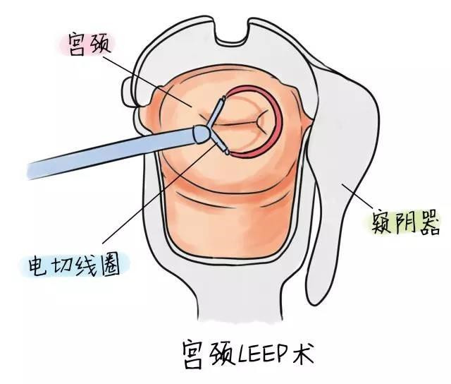 宫颈锥切缝合图解图片