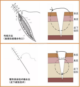论腹壁整形中的减张缝合法