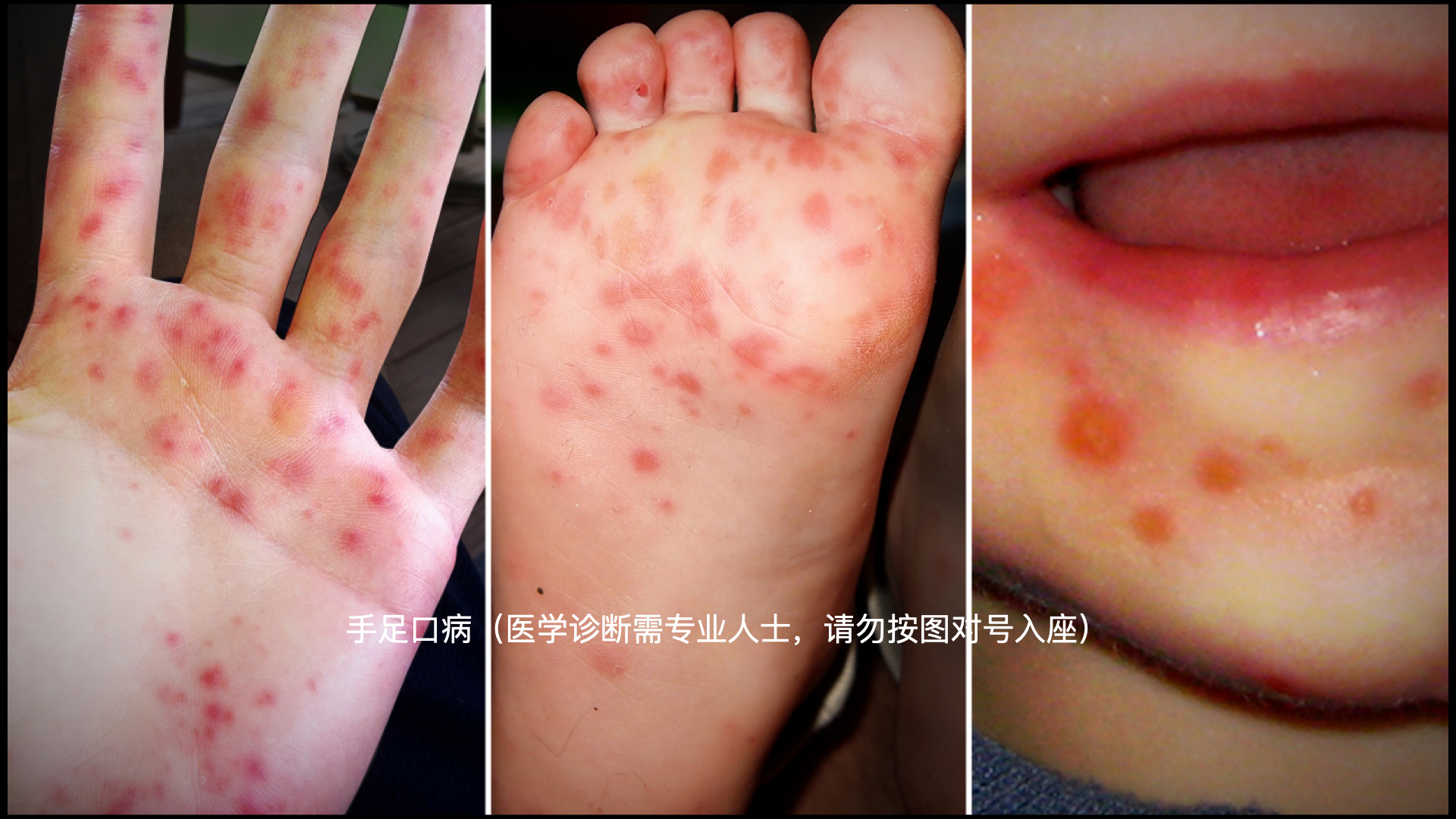 娃儿满嘴溃疡不吃不喝还发热多半是得疱疹了