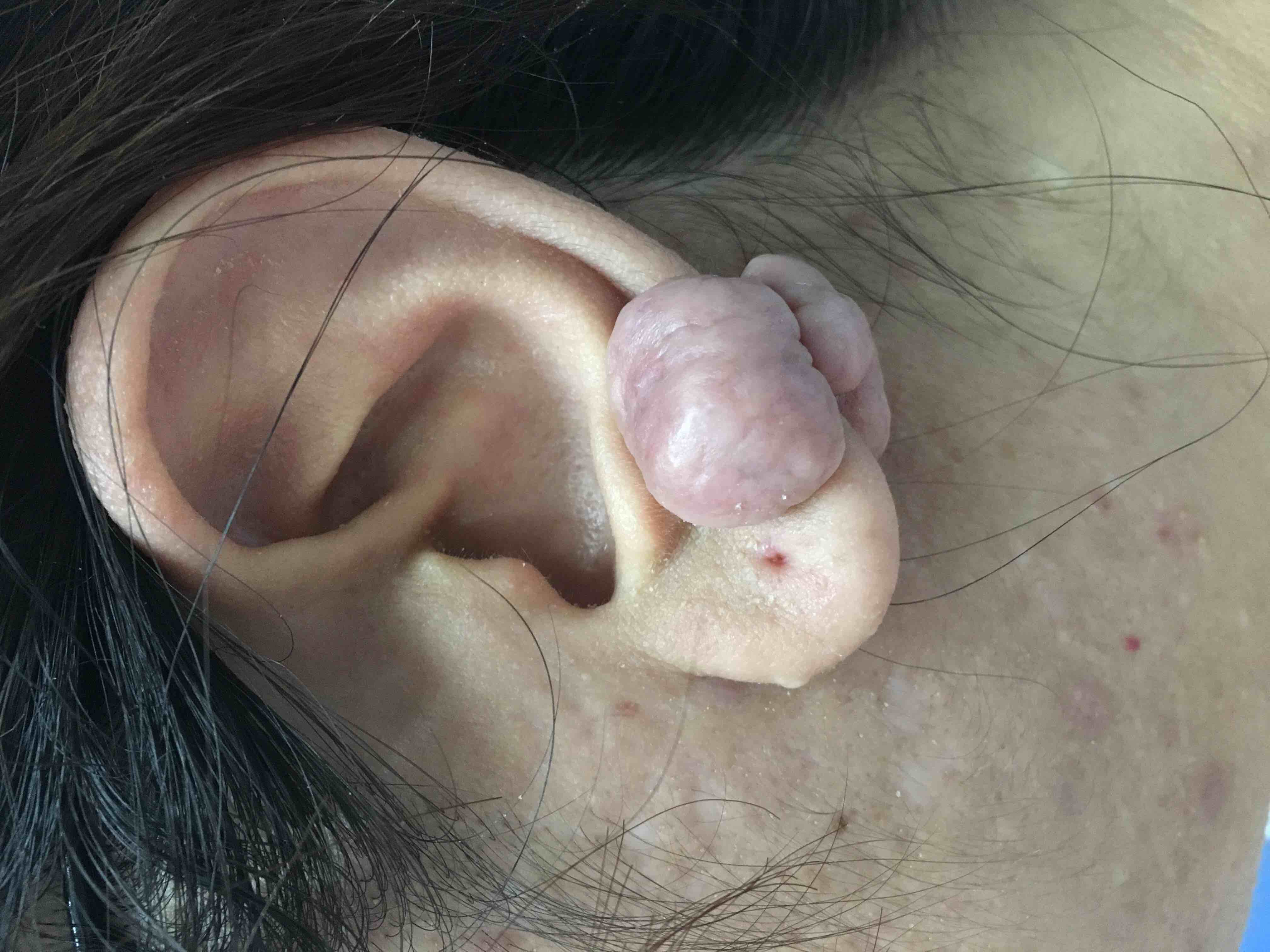 耳朵瘢痕疙瘩照片图片