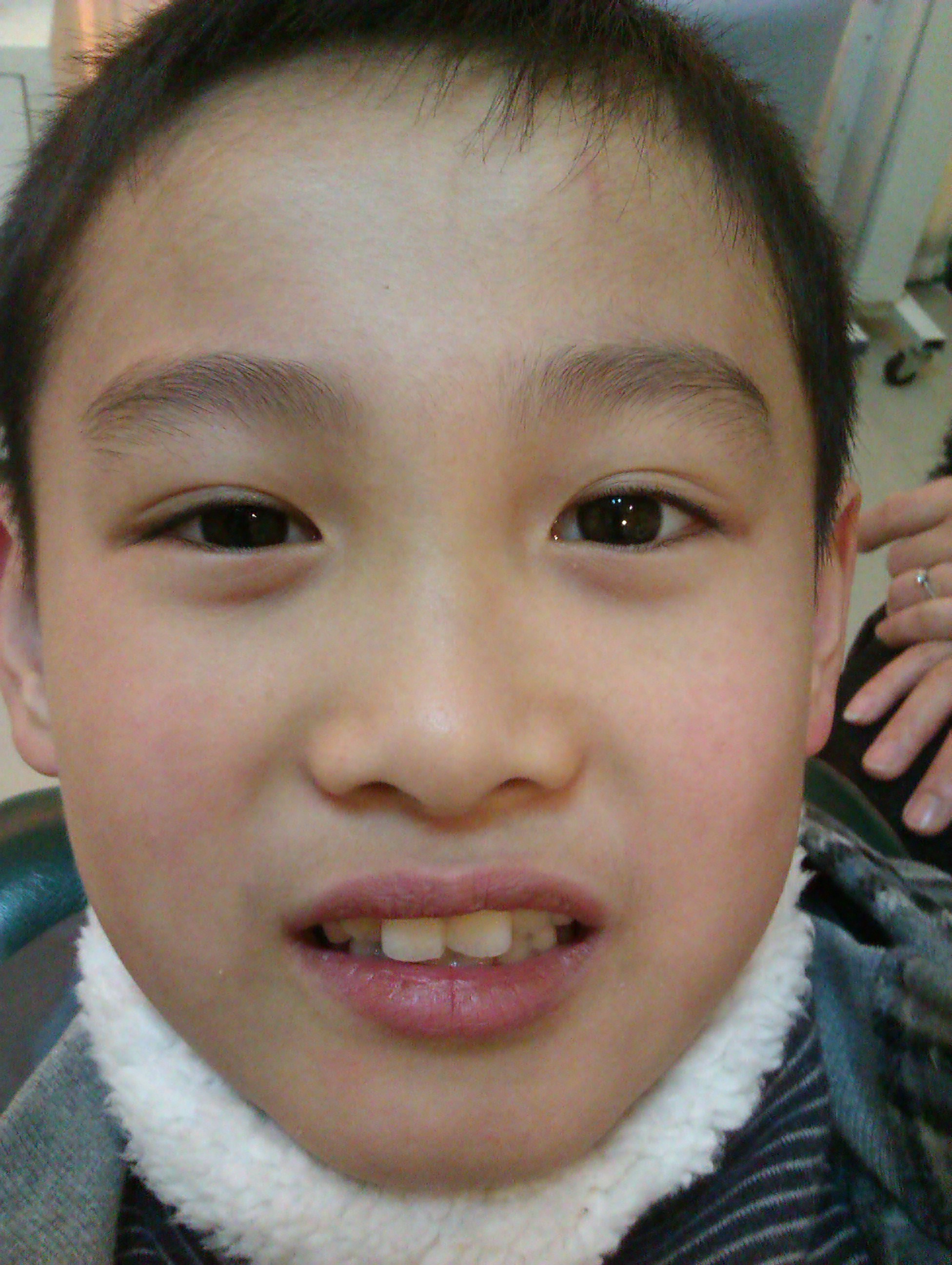 儿童错颌畸形应早期关注