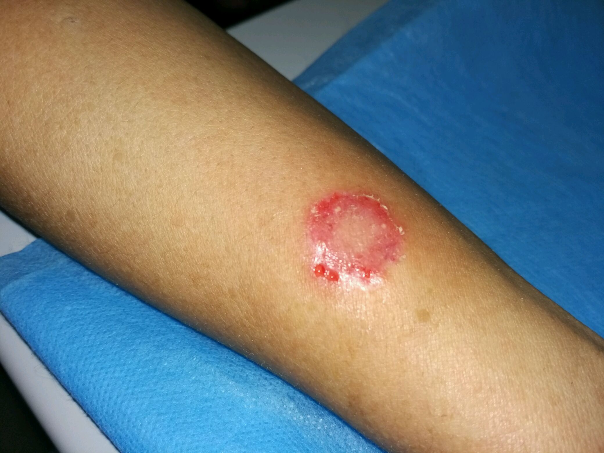 体癣,真菌感染导致,开始常为一处或几处红斑,丘疹或水疱,干燥后脱屑