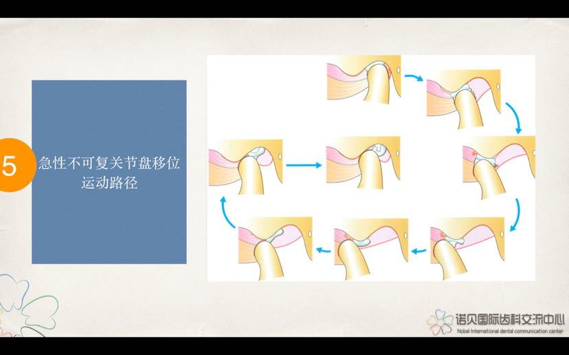 颞下颌关节弹响你留意了吗