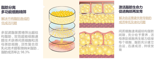 笼骨结构空间注射和浅层多维羽式注射相结合,均匀逐层将脂肪细胞注入