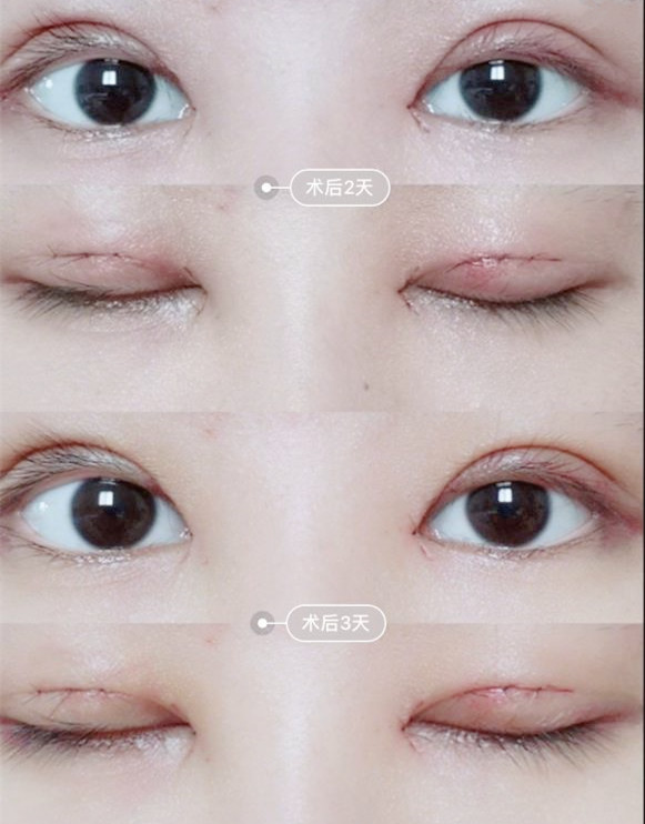 【图解】双眼皮手术的恢复过程,述说丑小鸭到白天鹅的蜕变