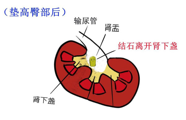 肾结石往下排的过程图图片