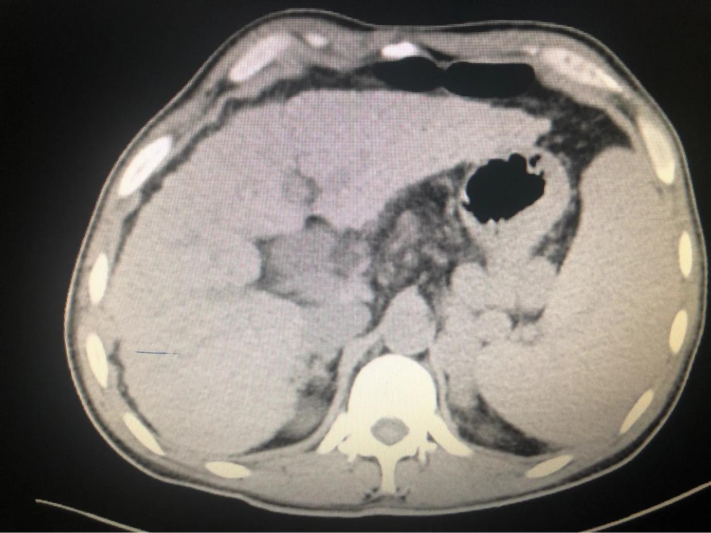 肝硬化如果恶化了都有哪些表现来听医生给你分析