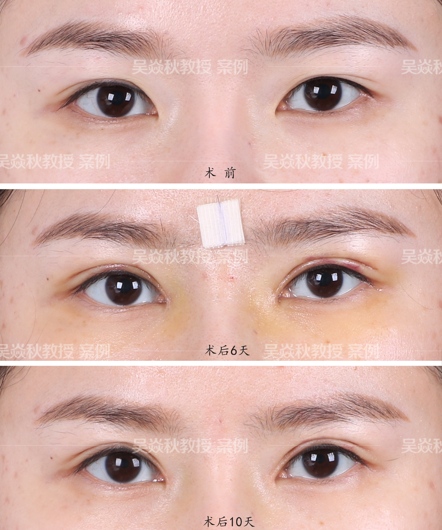 焱秋说眼|眼尾下垂显老怎么办?眉部提升术帮你年轻十岁!