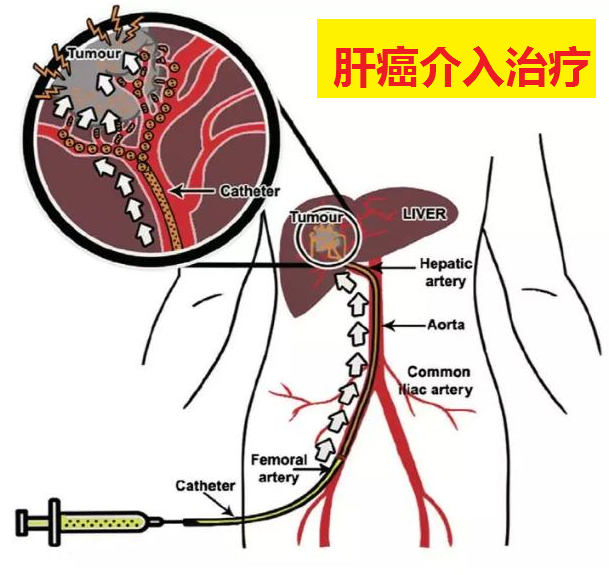 医学科普:介入科是干什么的?