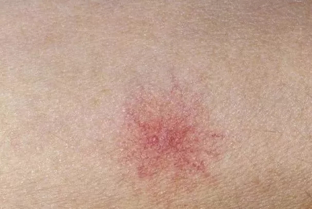 看着像蜘蛛一样的痣蜘蛛痣