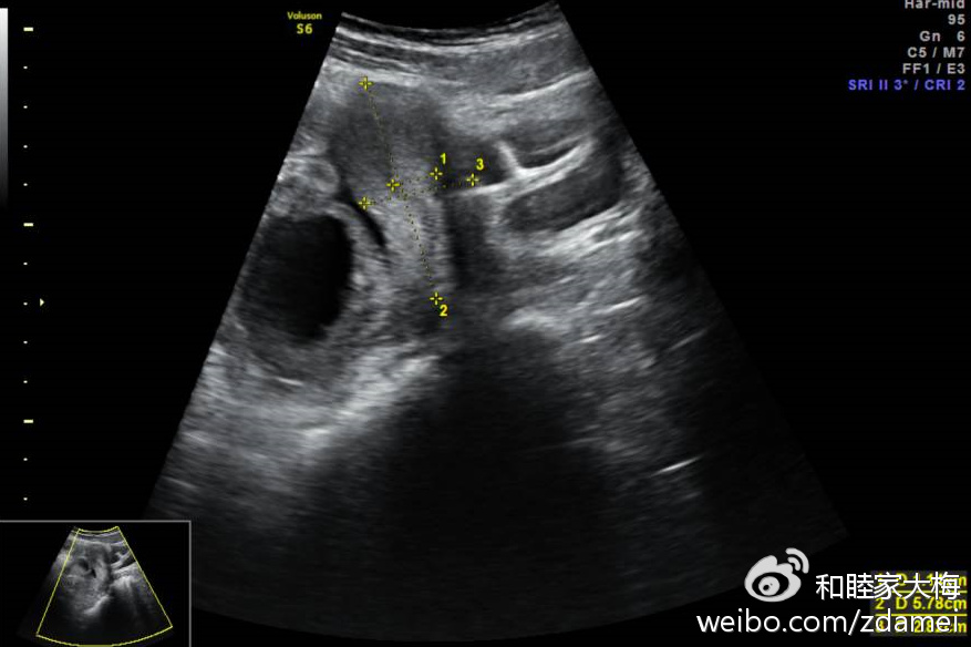 疼痛6-8/10;医生查体发现:右侧腹部压痛反跳痛明显,触到不移动的包块