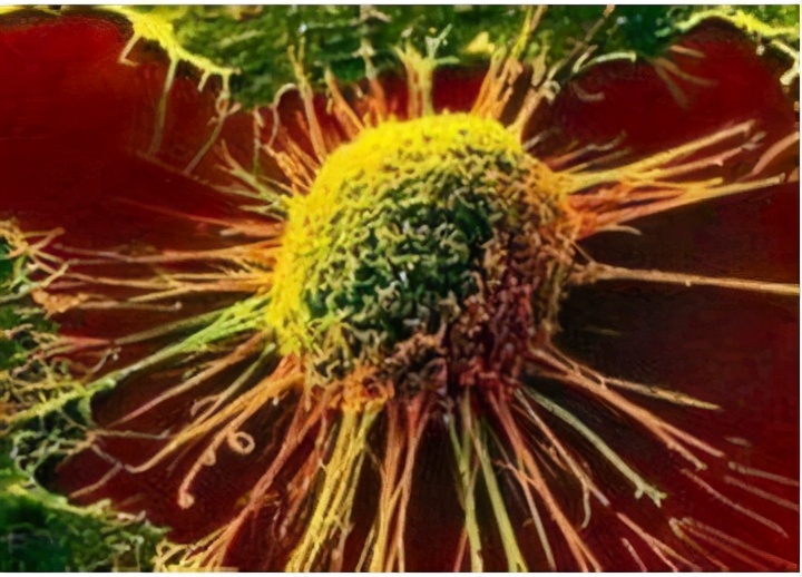 毛细胞白血病是一种少见的b淋巴细胞肿瘤,常以全血细