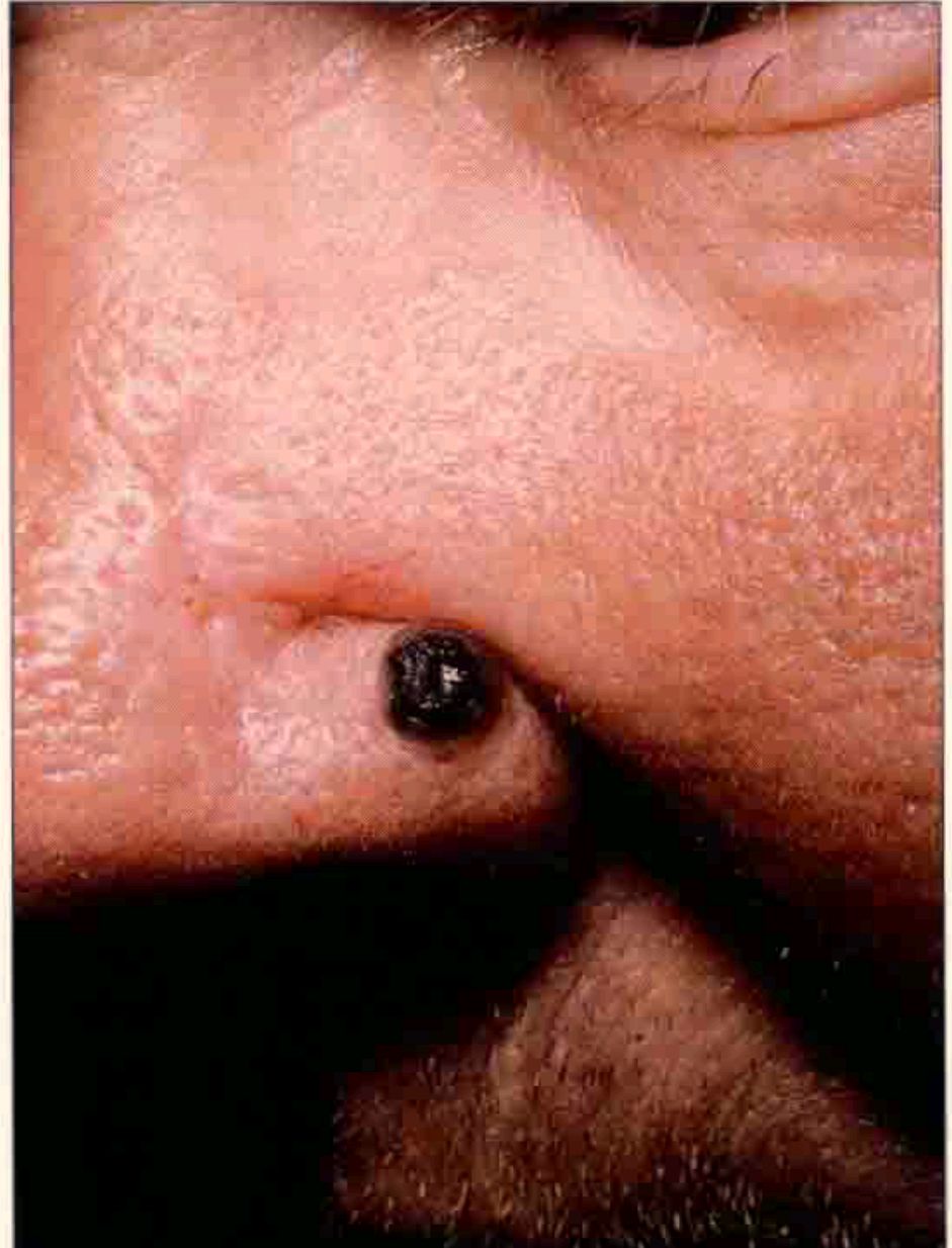 6.结节性黑色素瘤鼻部黑色结节出现溃疡7.