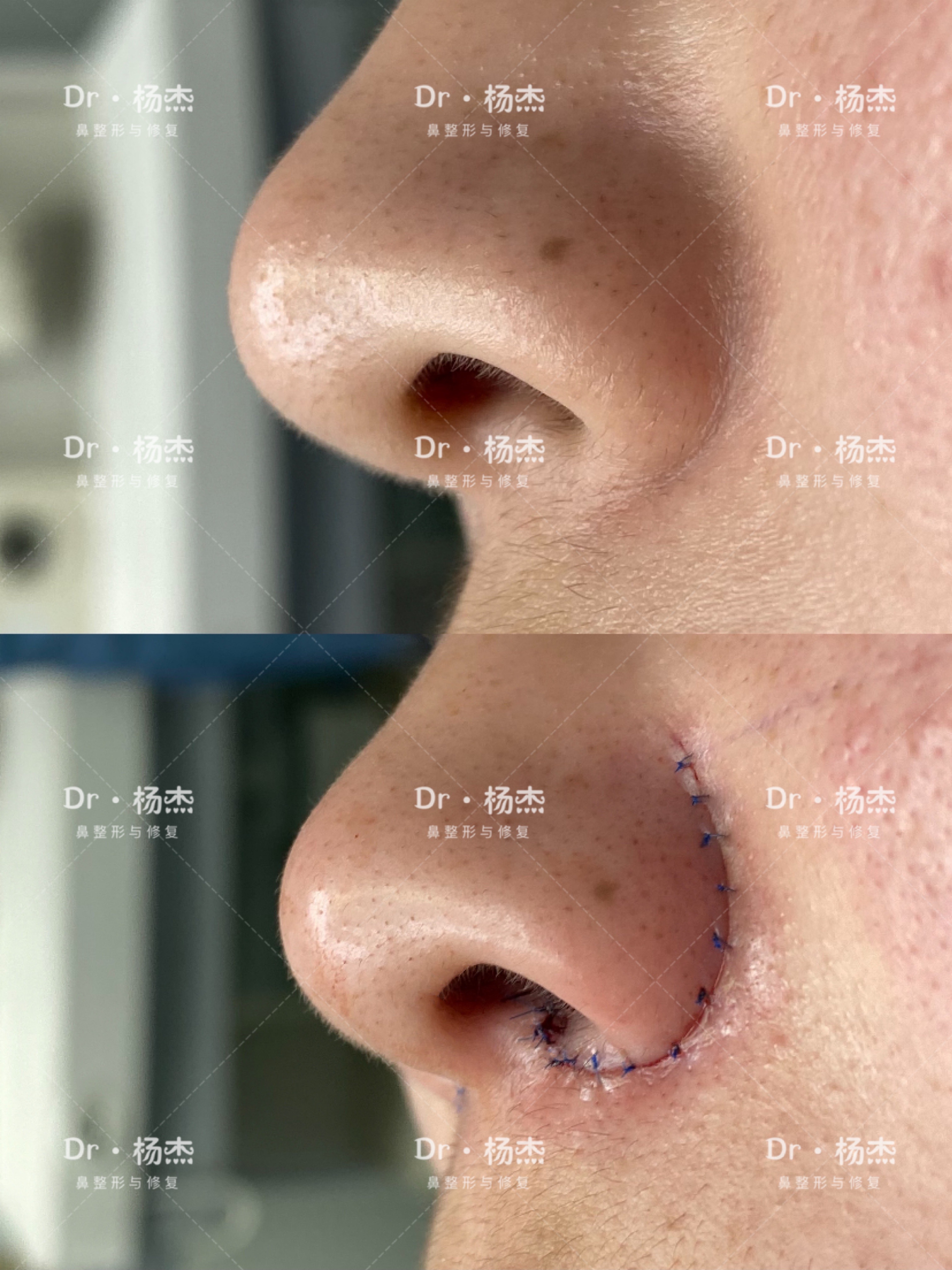 从鼻塞引发的一场功能性鼻整形-健康教育-清华大学附属北京清华长庚医院整形外科