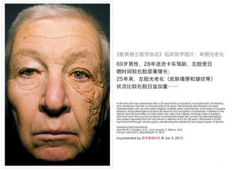 下面这位老司机就是典型的光老化案例.