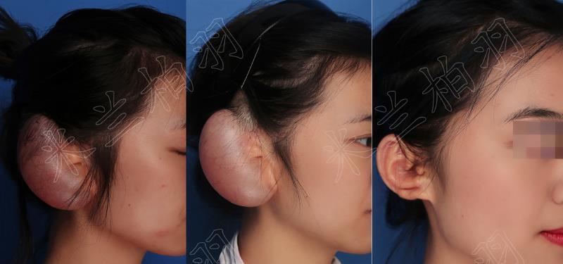 耳再造的手术方式应该如何选择?