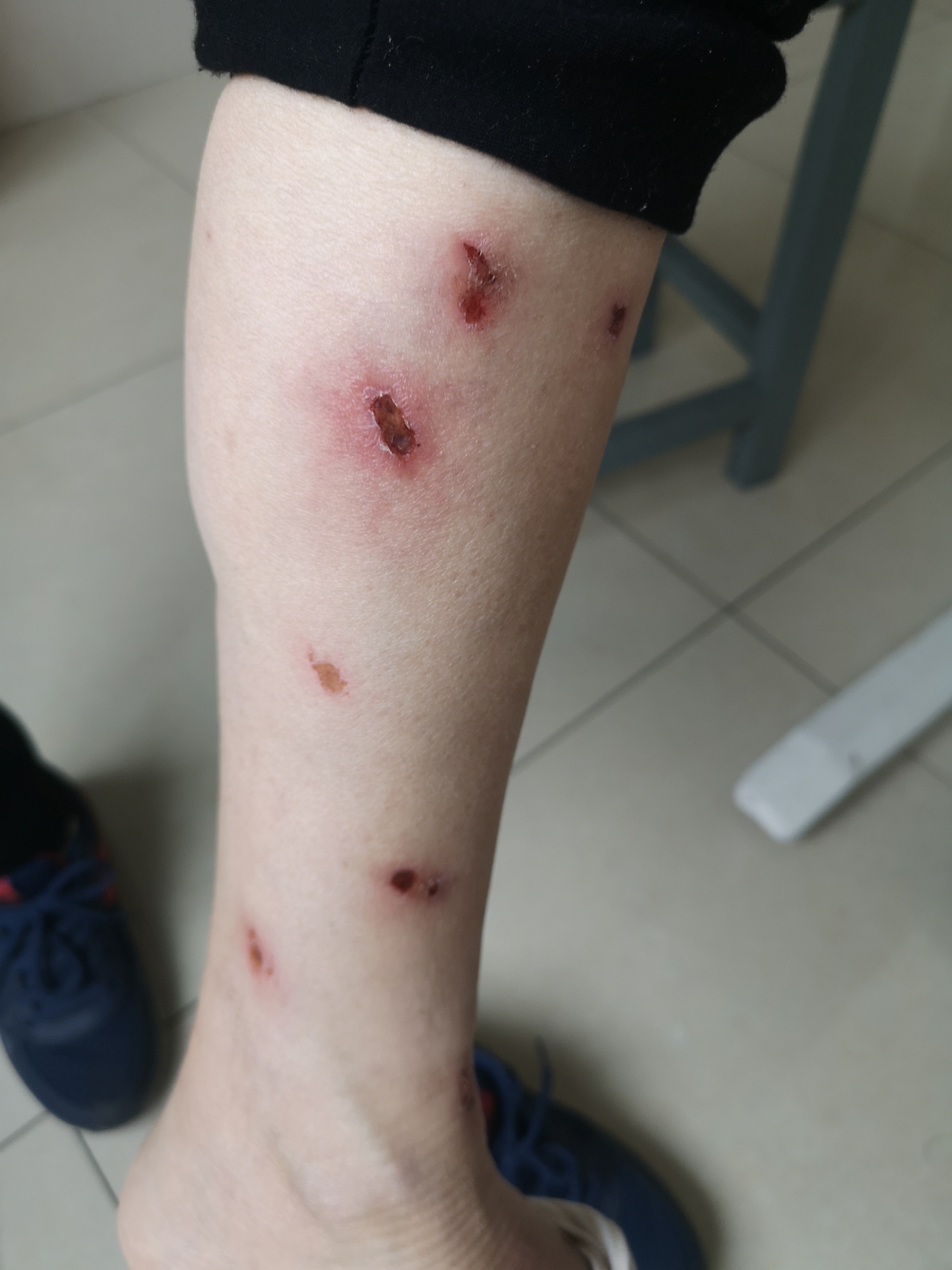 皮肤里面长水泥