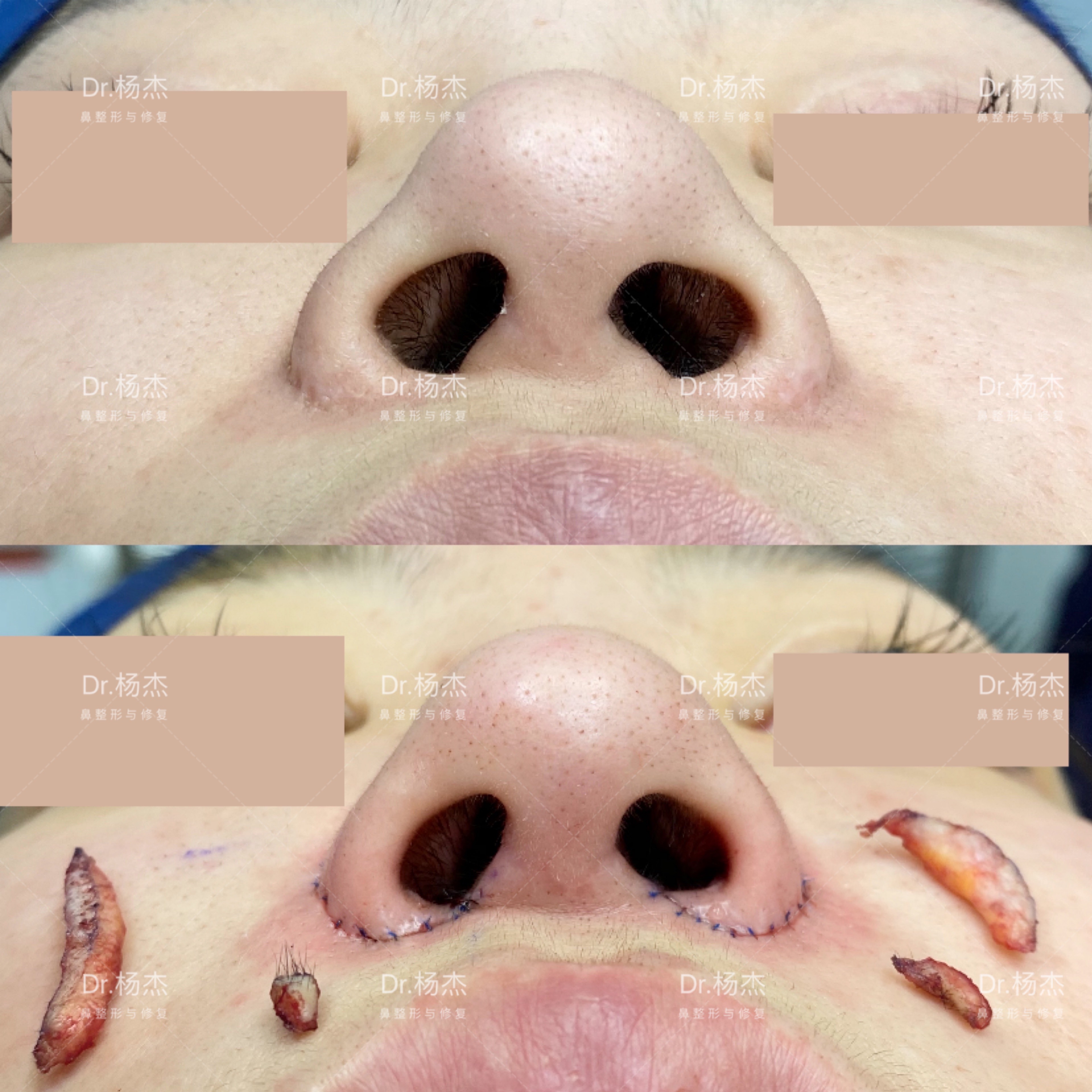鼻翼疤痕修复切除