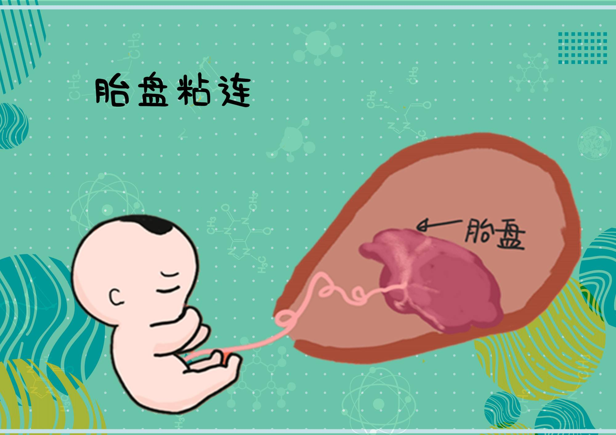 和宫外孕的宝妈由于手术原因,子宫壁相对较薄,胎盘粘连的概率会增加