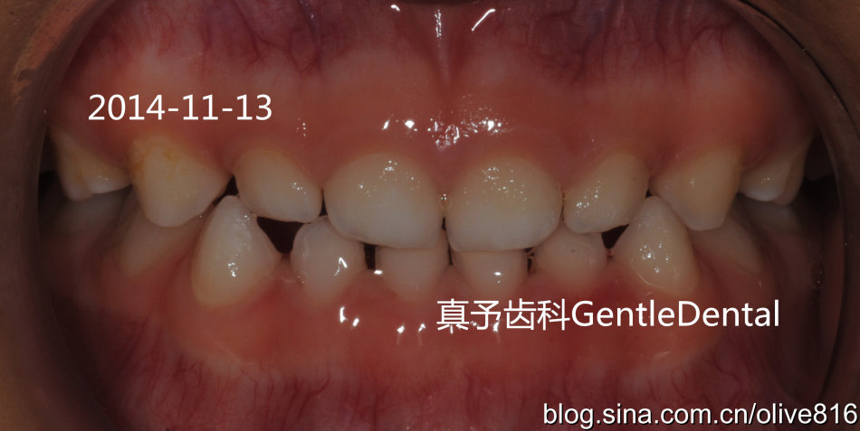 乳牙反合联冠斜导矫正过程照片一例