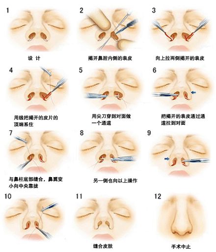 鼻翼变小鼻小柱缩窄术.jpg