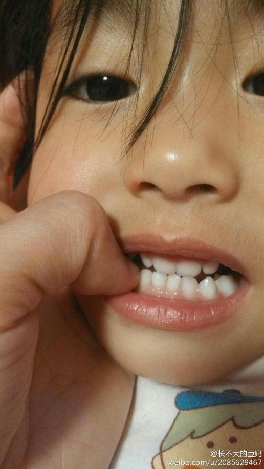 帮我看看我家宝宝的牙齿,大门牙上有白点,还有就是下排牙牙龈好像有?